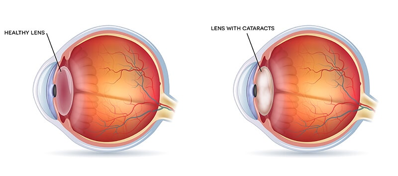 Chart illustrating a healthy lens compared to one with a cataract